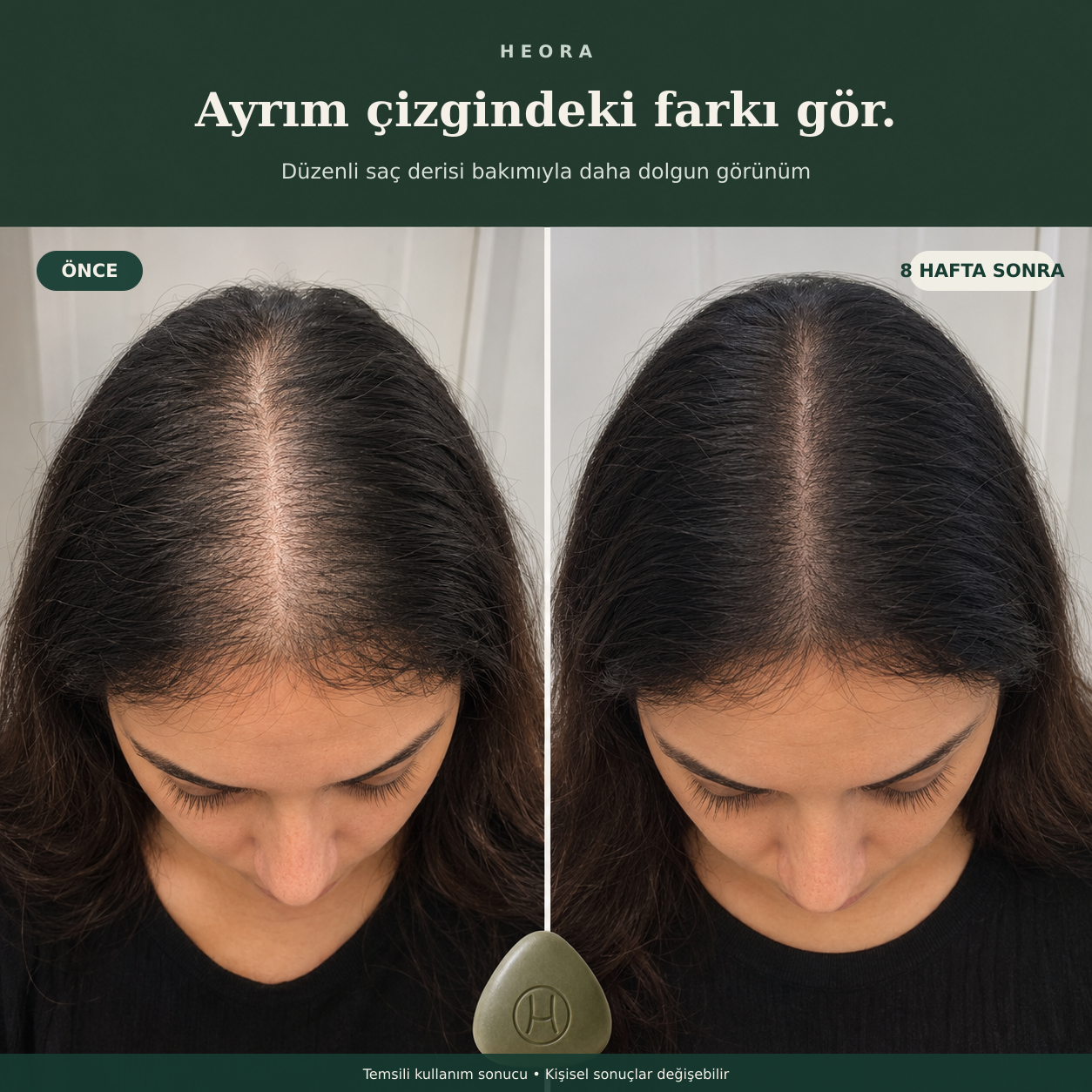 HEORA saç ayrımı görünümü önce ve 8 hafta sonra